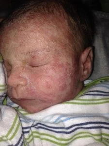 a baby with red rash on its face description auto 1 e1718501003908 225x300 1
